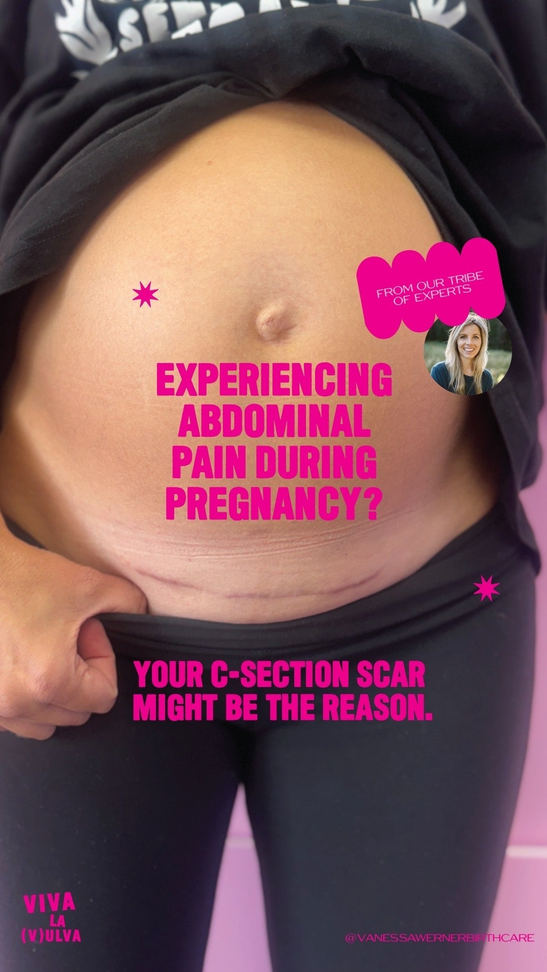 Experiencing abdominal pain during pregnancy? Your c-section scar may be a reason why…